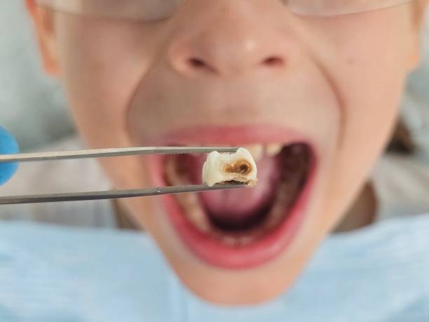 Best Emergency Dental Care for Broken or Chipped Teeth in George West, TX